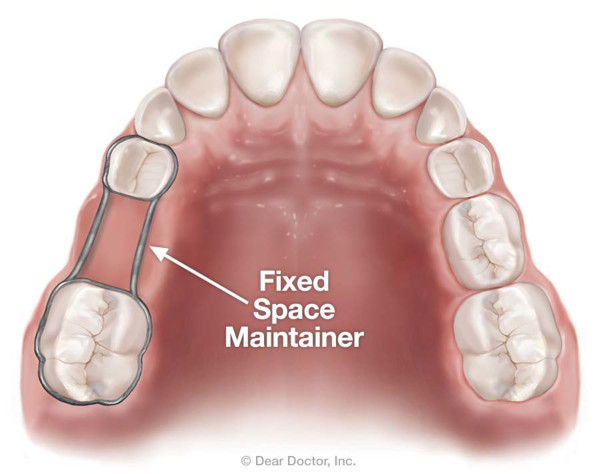 Space maintainers