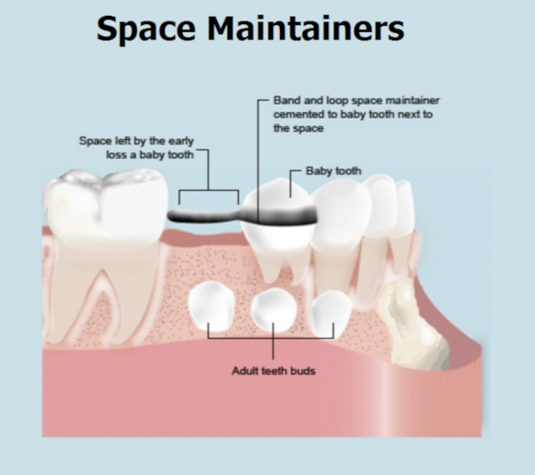 Space maintainers 3